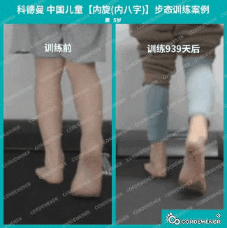 科德曼|儿童步态训练案例展示--内旋案例二十七