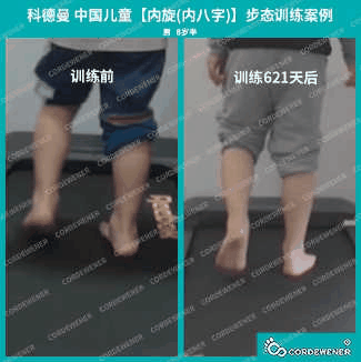 科德曼|儿童步态训练案例展示--内旋案例二十九 