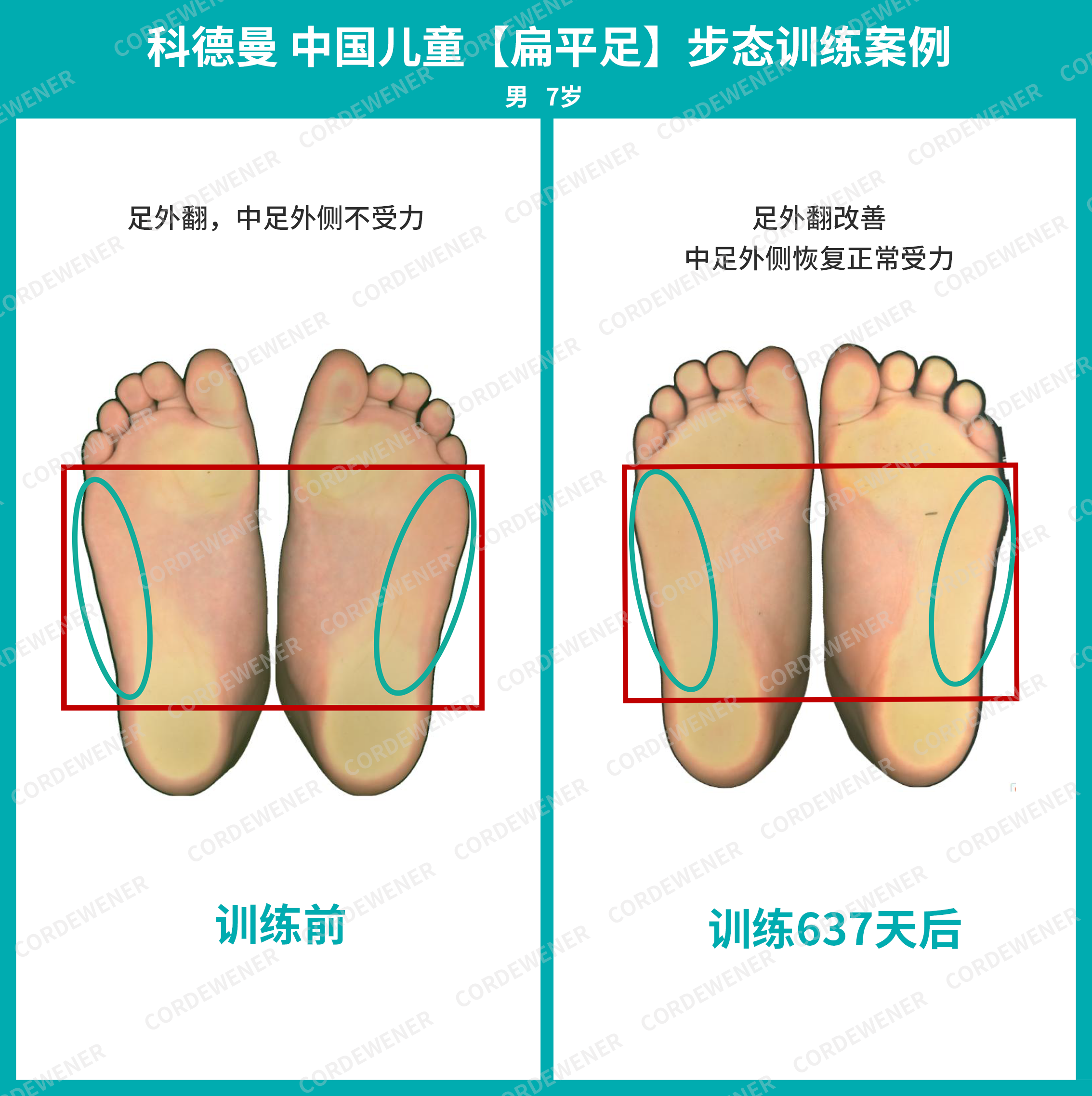 科德曼|儿童步态训练案例展示--扁平足案例五十